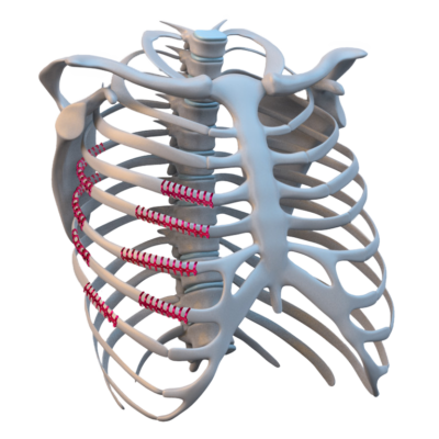 Rib Clips - MediGroup EBI